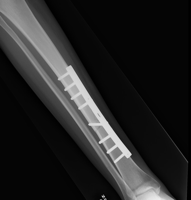 Midshaft Tibial Fracture The Bone School 0094